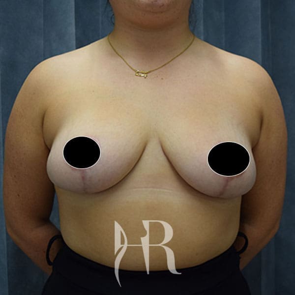 HR Plastic Surgery - Breast Reduction patient after 1